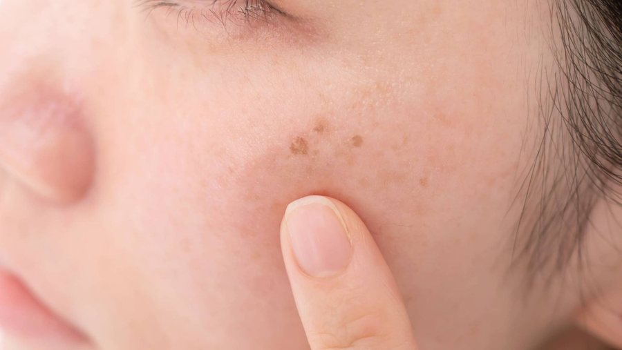 Autres traitements laser – Traitement par laser pigmentaire