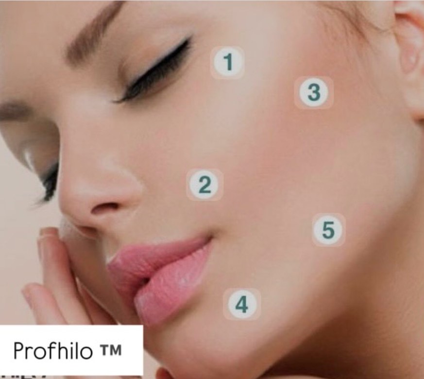 Points d’injection du Profhilo